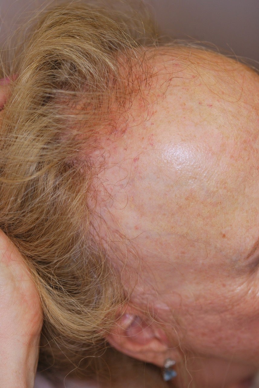 Frontal Fibrosing Alopecia | The Trichological Society
