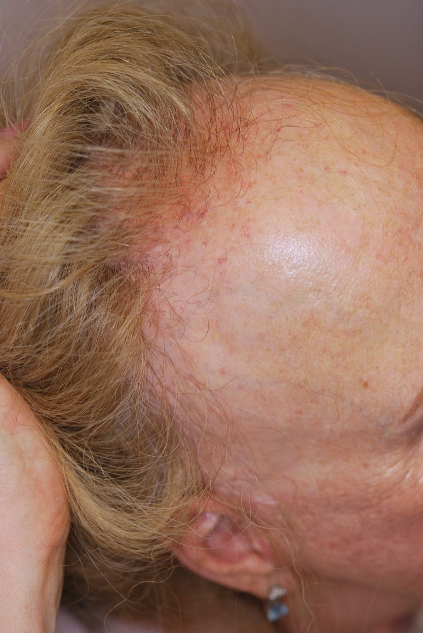 Frontal Fibrosing Alopecia Presenting as Androgenetic Alopecia in an  African American Woman  Next Steps in Dermatology